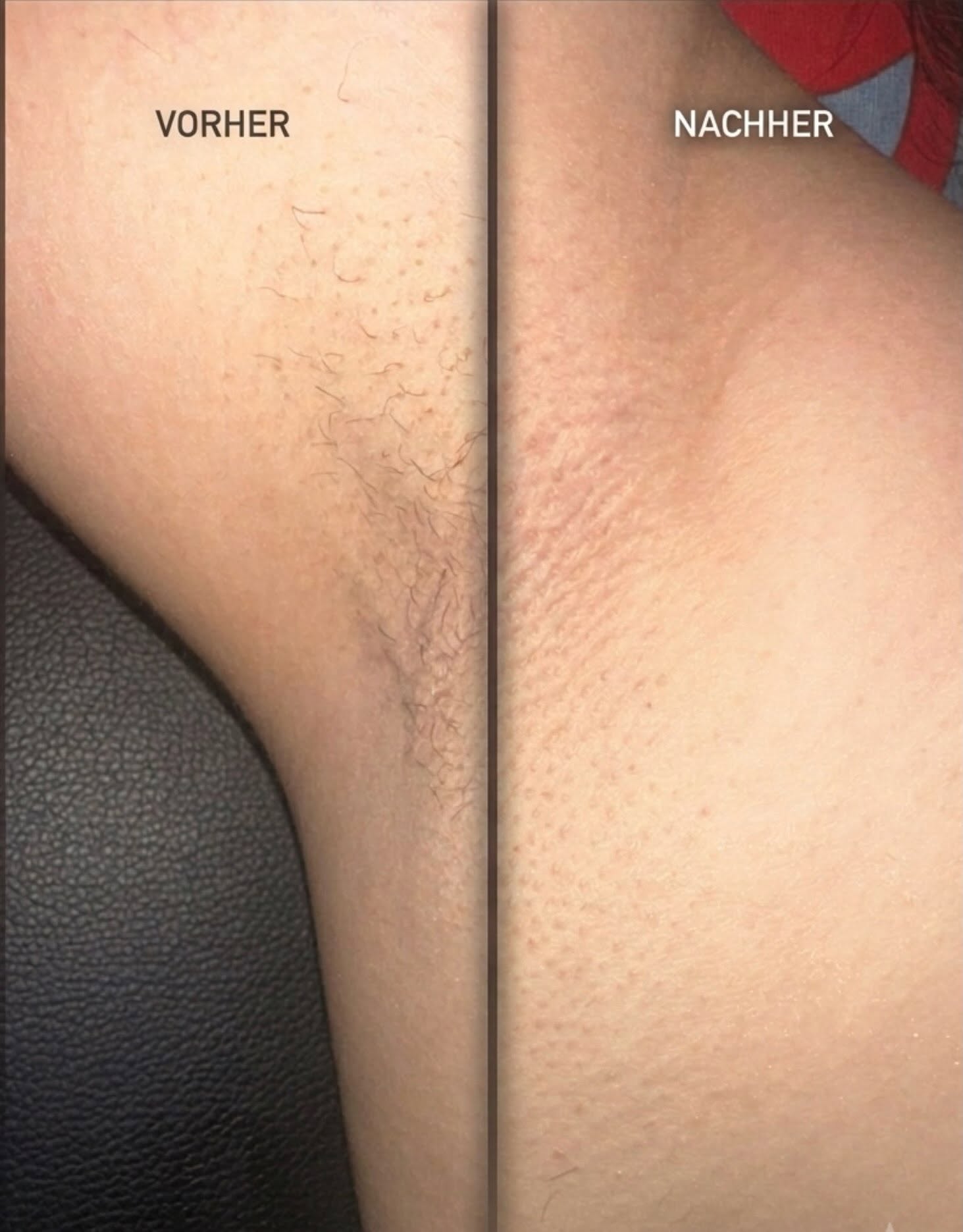 Vorher-Nachher: Achsel vor und nach dem Waxing bei Fati's Beauty & Wax in Muri AG